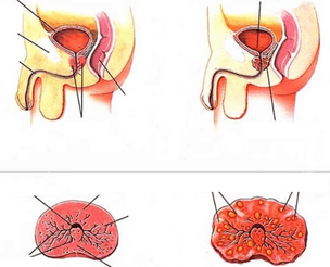 нормальна простата і хронічний простатит