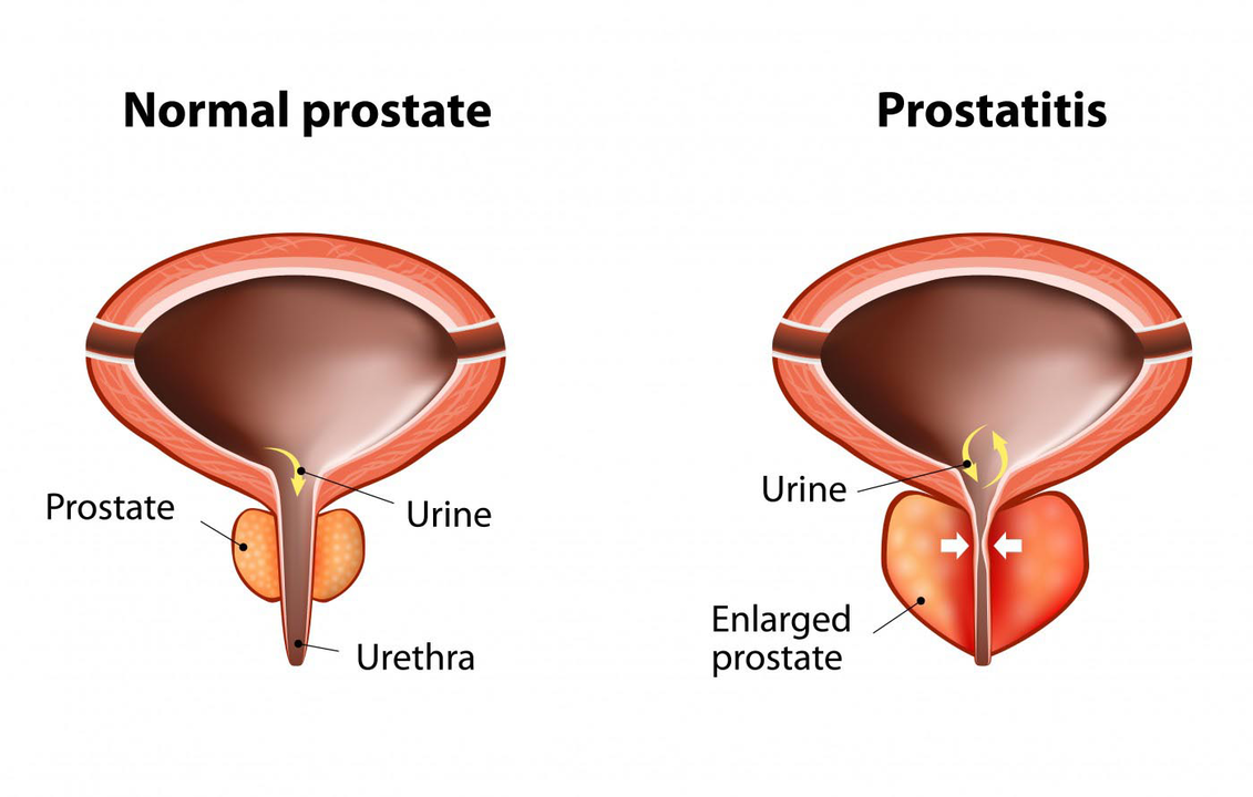 Нормальна простата здорового чоловіка та запалення передміхурової залози при простатиті